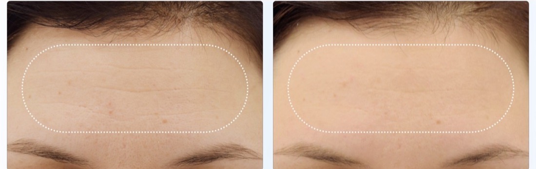 EMFace before and after