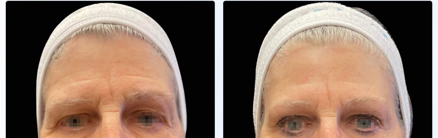 EMFace before and after