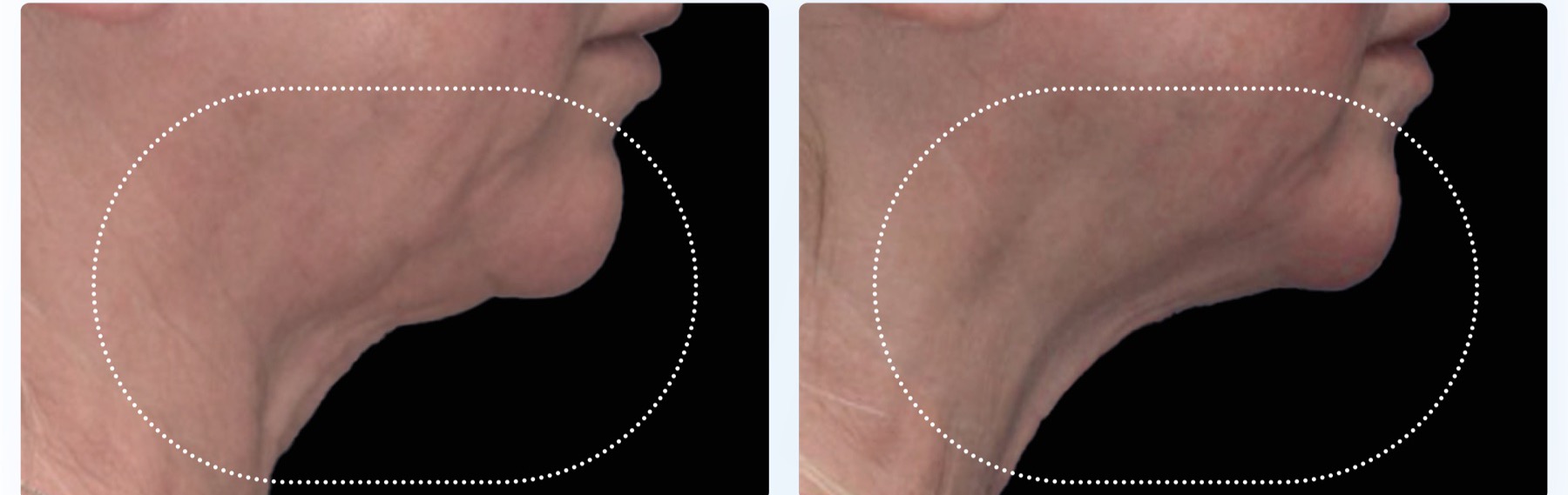 EMFace before and after