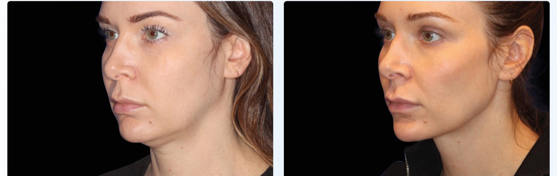 EMFace before and after