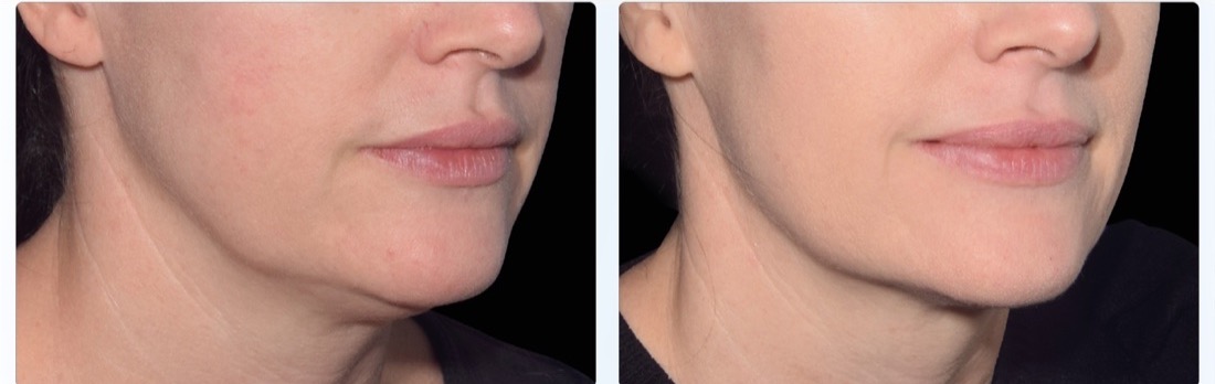 EMFace before and after — jawline and jowls