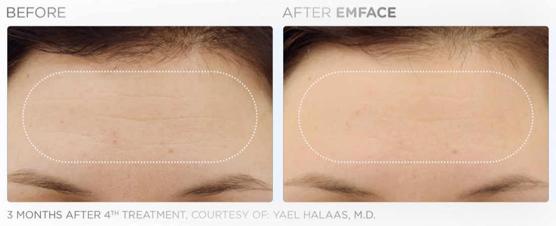 EMFACE before and after: forehead smoothing, 3 months after 4th treatment