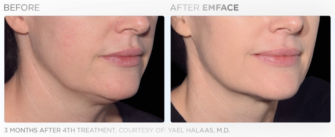 EMFACE before and after: jawline definition, 3 months after 4th treatment