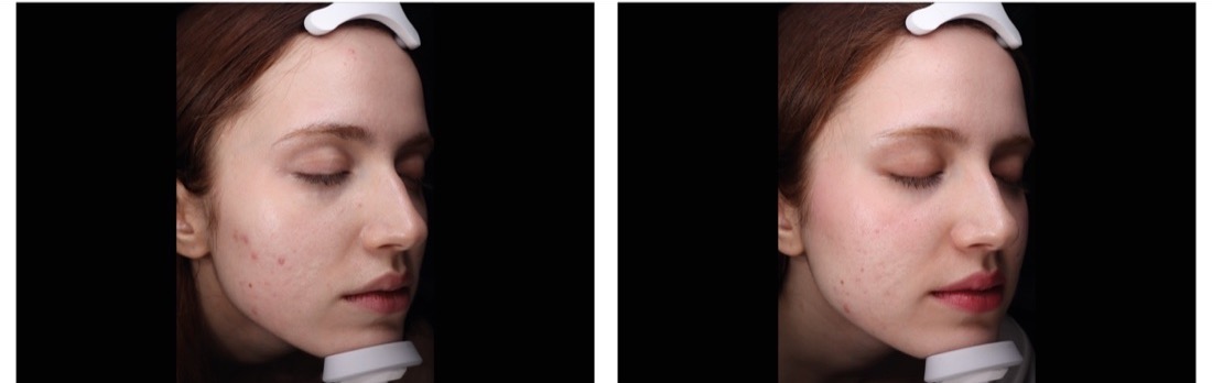 EMFusion before and after — Redness  blemishes