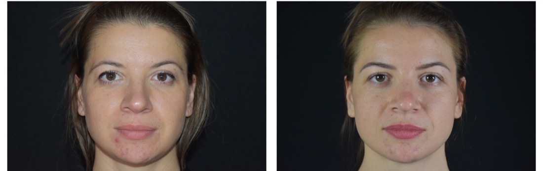 EMFusion before and after — skin clarity