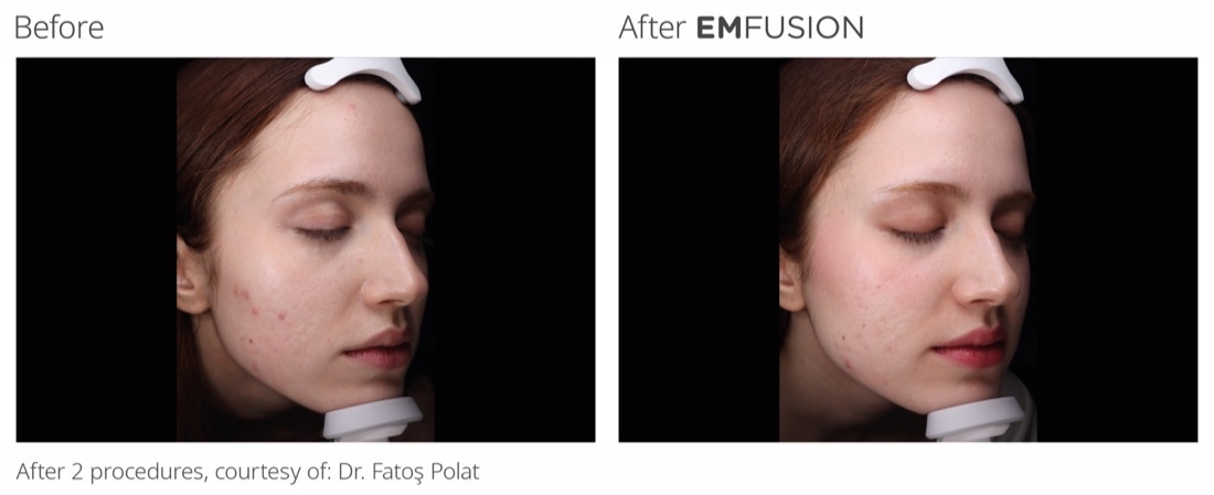 EMFUSION before and after, after 2 procedures