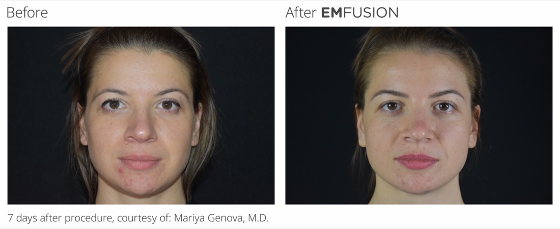 EMFUSION before and after, 7 days after procedure