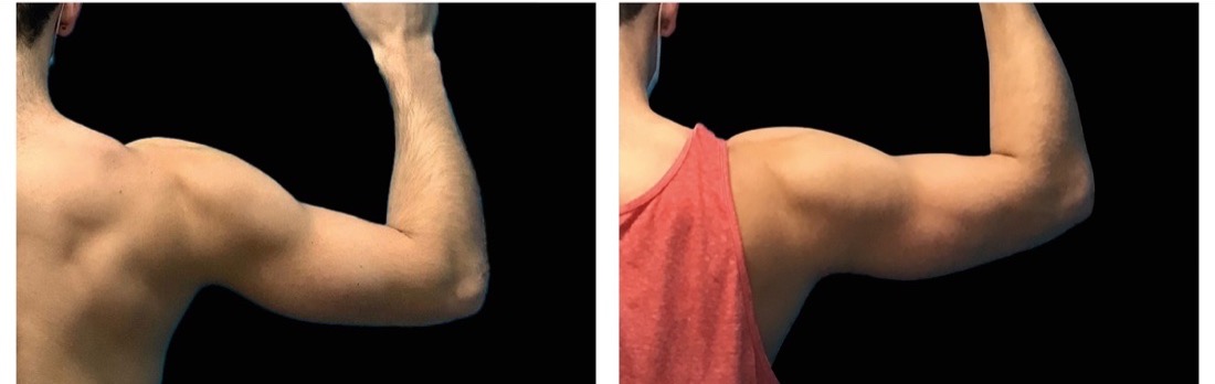 EMSculpt Neo before and after