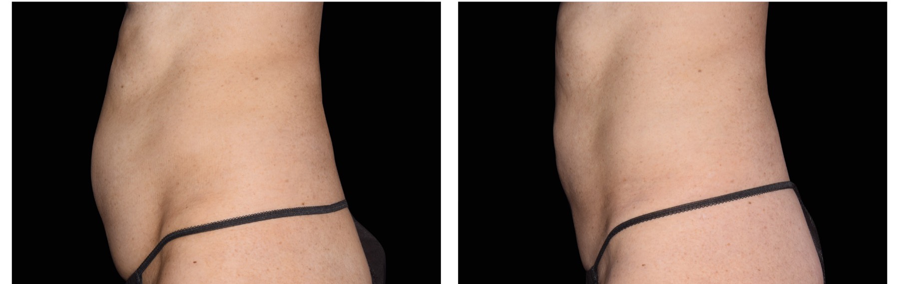 EMSculpt Neo before and after