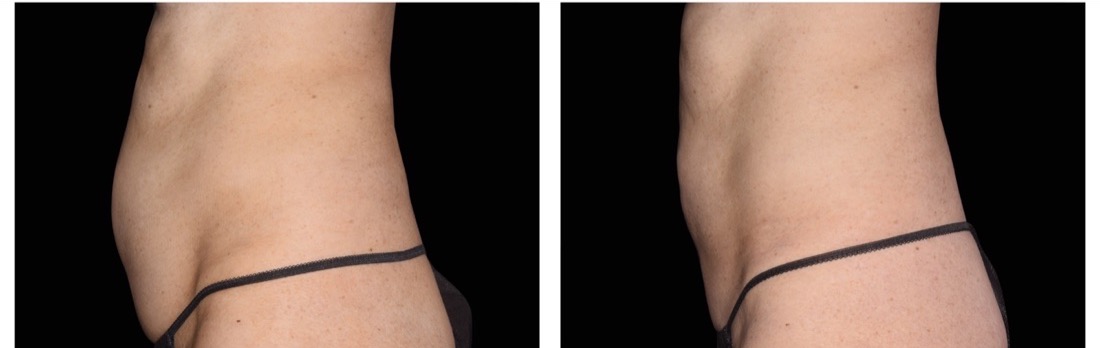 EMSculpt Neo before and after — abdomen