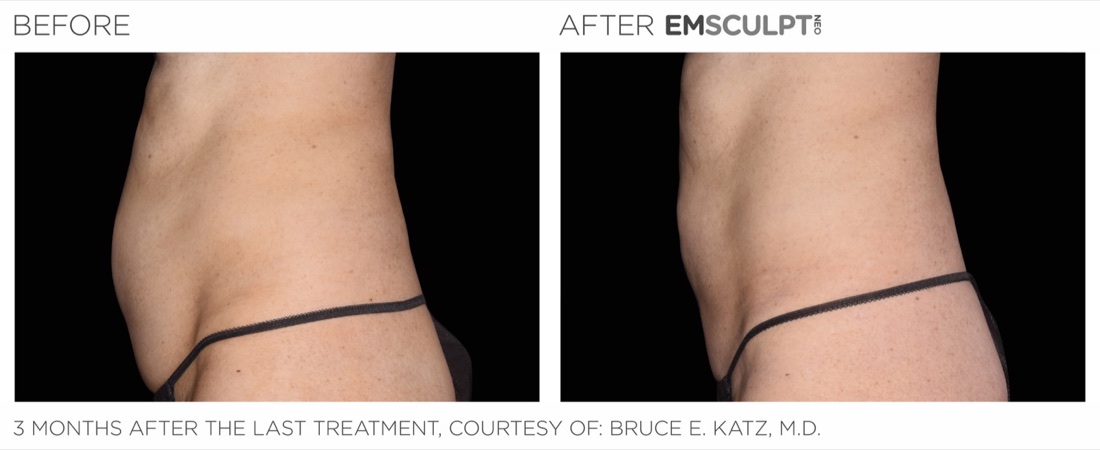 EMSCULPT NEO before and after, abdomen, 3 months after the last treatment