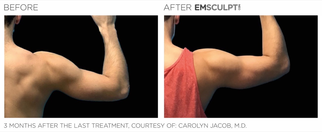 EMSCULPT NEO before and after, arms, 3 months after the last treatment
