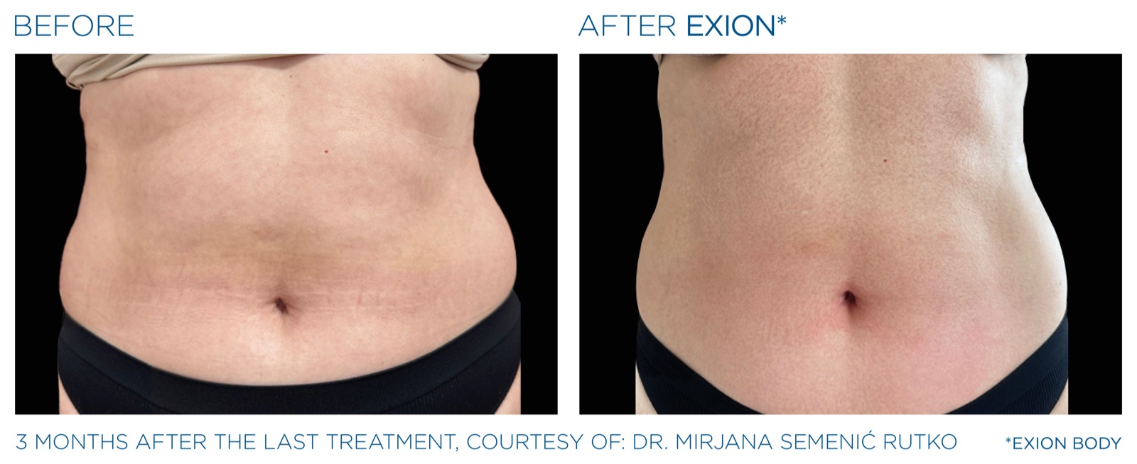Exion before and after — abdomen