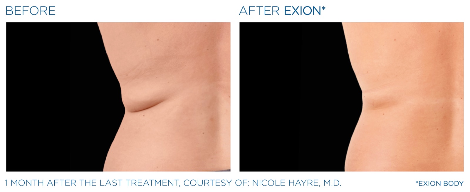 Exion before and after — back