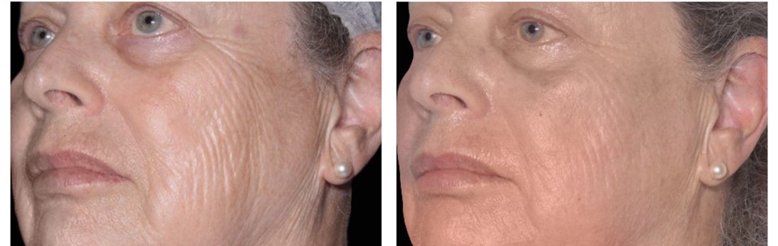Exion before and after — RF microneedling, cheek texture and firmness