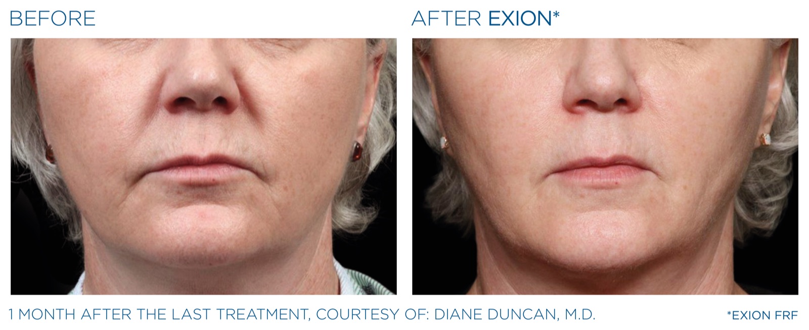 Exion before and after — mouth, fractional RF