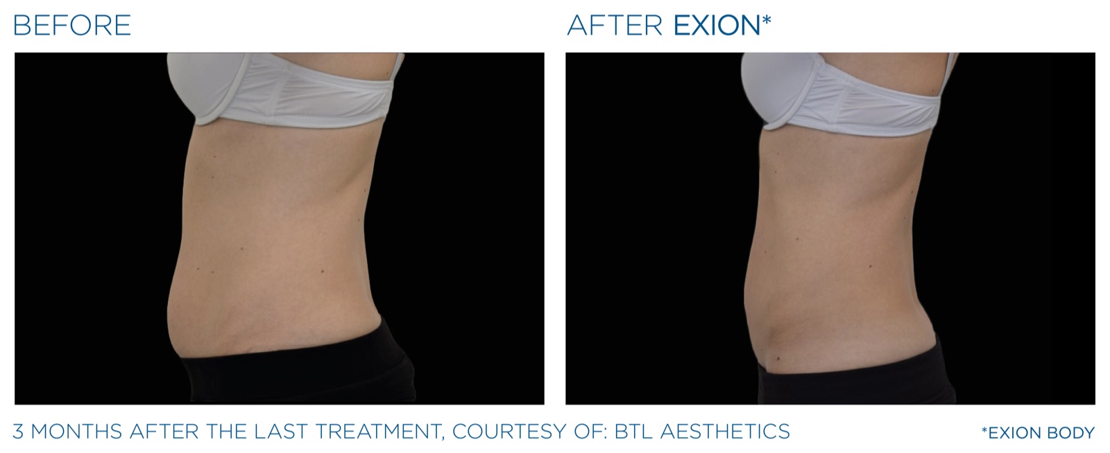Exion before and after — waist