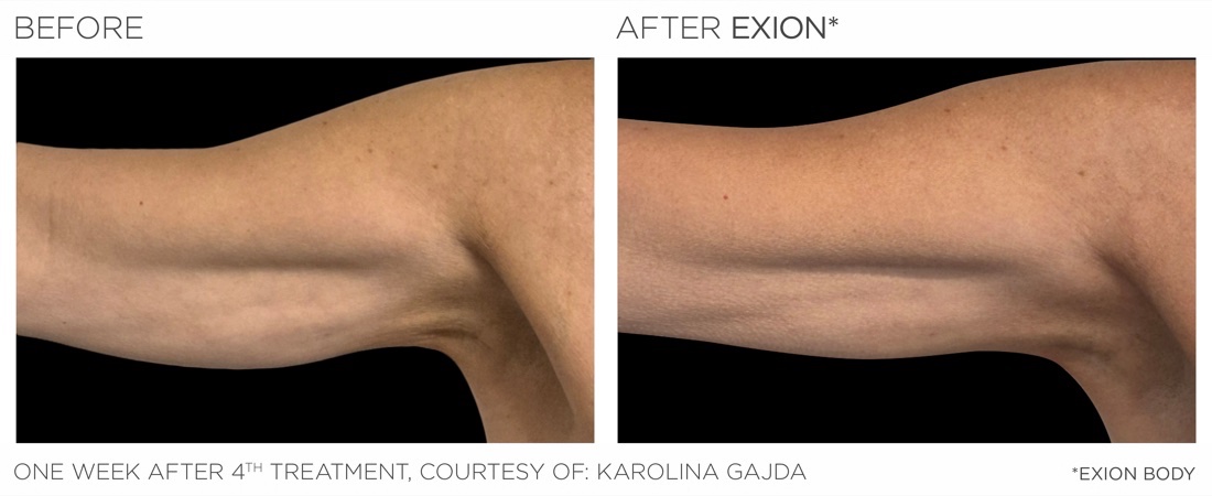 EXION Body before and after, upper arm, one week after 4th treatment