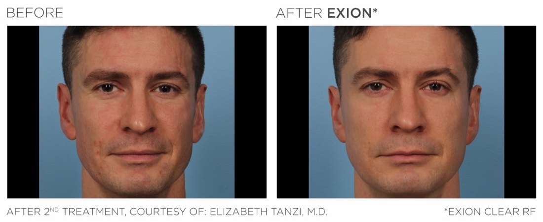EXION Clear RF before and after, face, after 2nd treatment