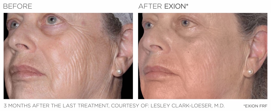 EXION fractional RF before and after, cheek, 3 months after the last treatment